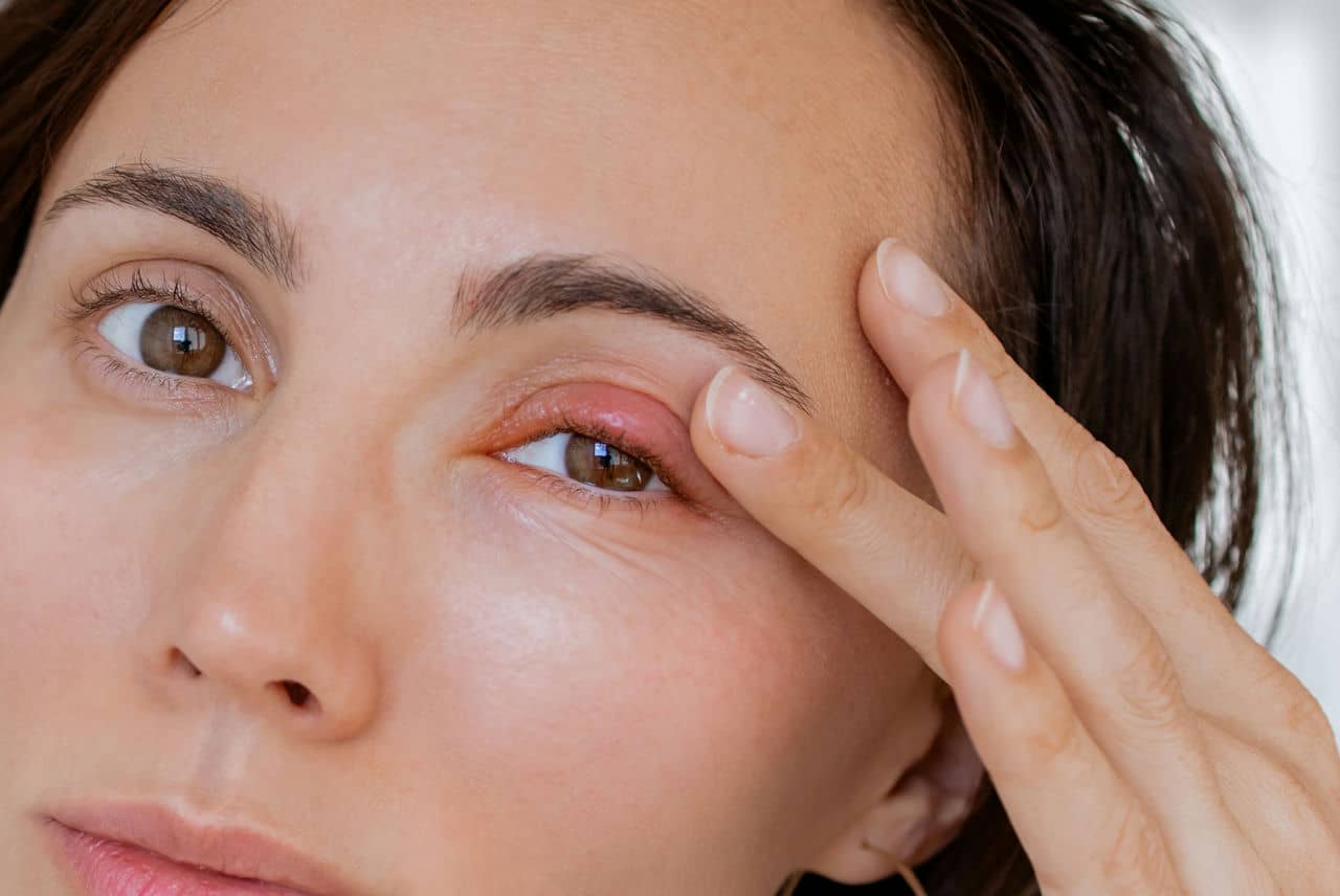 image of a womans face, focused on the right eye, the upper eyelid is swollen and red and she has her hand to her face